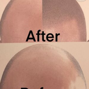 Male Pattern Baldness