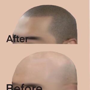 Male Pattern Baldness