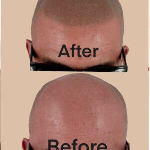 Male Pattern Baldness