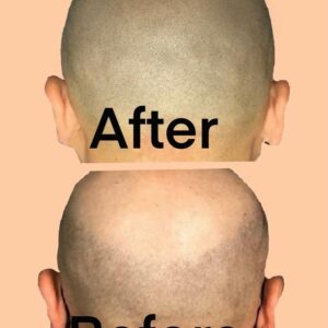 Male Pattern Baldness