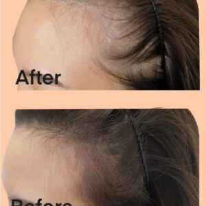 Women's Hairline Density