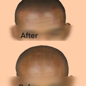 Male Pattern Baldness