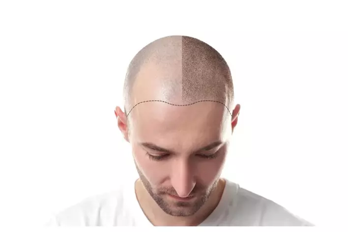 Hair transplant before and after.