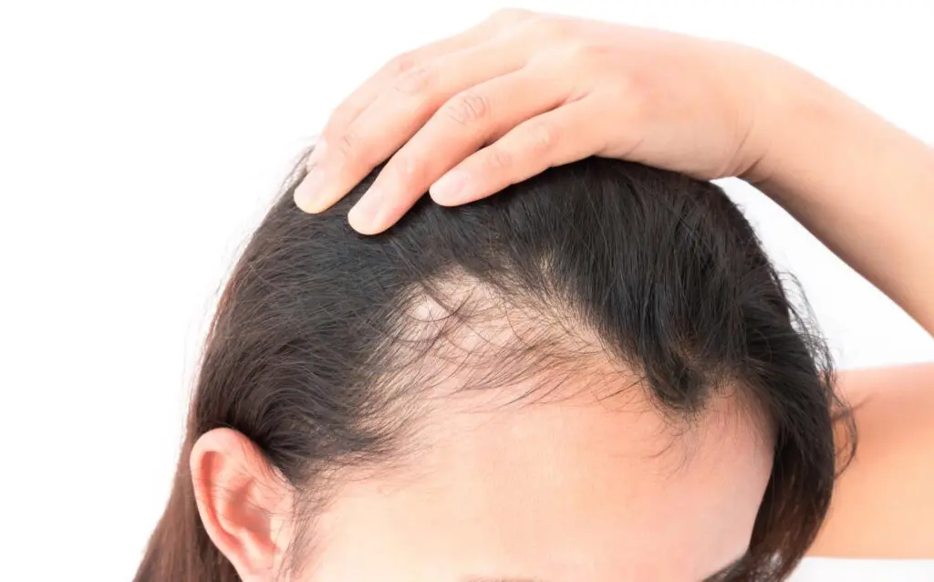 Woman's thinning hair and receding hairline.