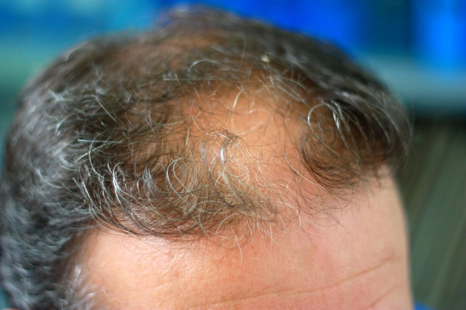 Close-up of receding hairline with graying hair.