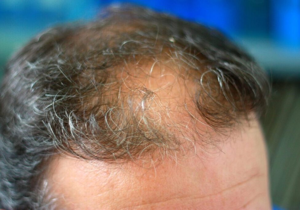 Close-up of receding hairline with graying hair.