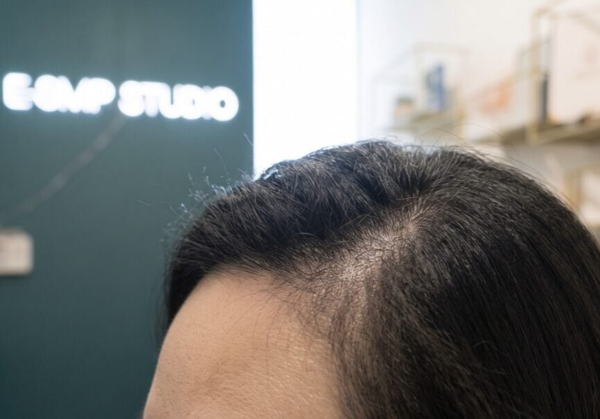 Illustration of a woman's thinning frontal hairline and temple, representing women's hairline SMP concerns.